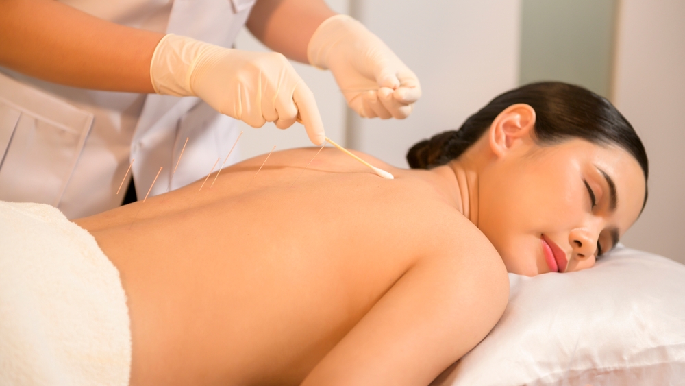 Acupuncture