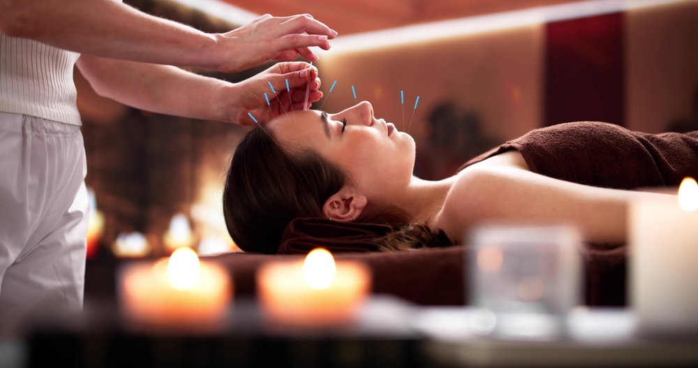 Acupuncture